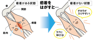 癒着が起きている時の筋肉の状態