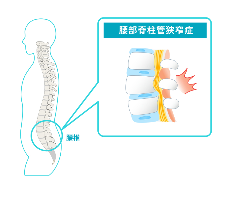 神経が圧迫されているイラスト